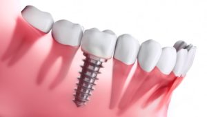 Dental Implants treatment