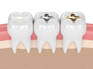 metal and composite fillings