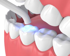 model of dental filling